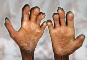 Leprosy01 (175 x 122)